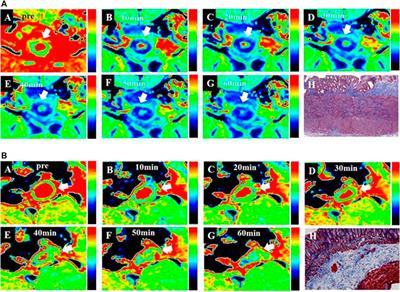 A Type I Collagen-Targeted MR Imaging Probe for Staging Fibrosis in Crohn’s Disease